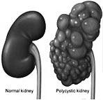 Rene policistico infantile Carattere autosomico recessivo Più rara (1/40.