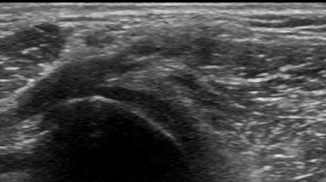 11 ".' Sul versante posterolaterale del ginocchio è possibile esaminare il muscolo bicipite femorale e il suo