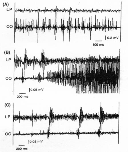 Caratteristiche Elettrofisiologiche A riposo: - assenza di attività - contrazioni brevi (>100 ms) o protratte ( 500 ms), talora con scariche ritmiche. Aramideh et al.