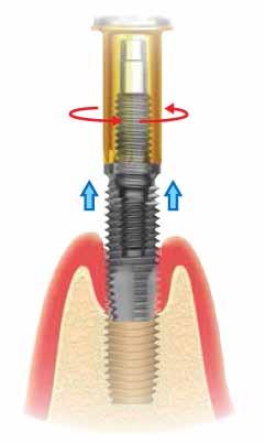 Implant Removal Kit KIT UNIVERSALE per RIMOZIONE FRKIT Implant Removal Kit Per rimuovere facilmente, senza traumi, ance un impianto osteointegrato Impianti ce possono essere candidati alla rimozione: