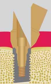 Il minor ingombro della vite di ritenzione protesica del pilastro avvitato alla connessione Certain (1,96 invece dei 3,5 imposti con l esagono esterno) aumenta lo spazio protesico.