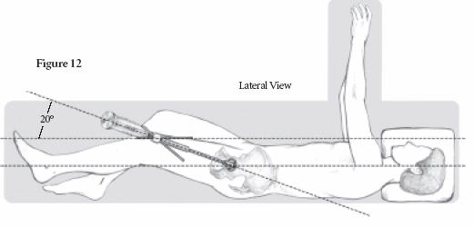 Sistema acetabolare Trident Tecnica operatoria Fase 5: impianto del cotile emisferico e acetabolare PSL Trident HA (continua) Determinare l angolo di abduzione di 45 consigliato per il cotile