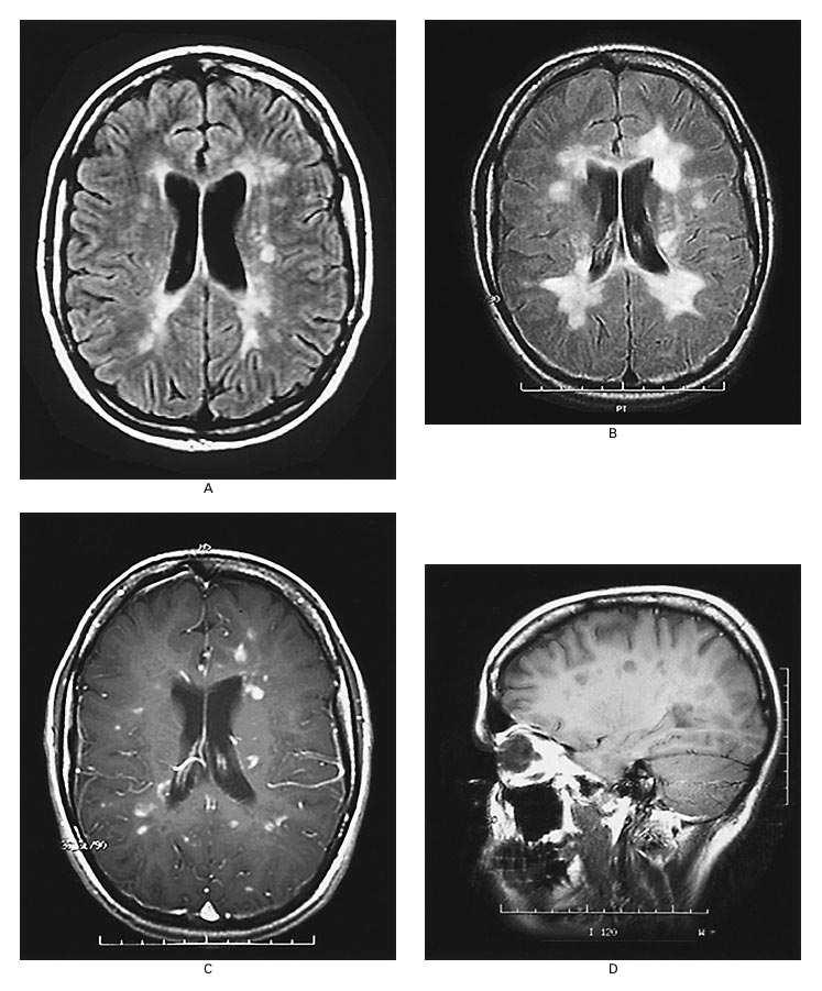 Attack New MRI Lesion = MS (McDonald) Secondary Progressive Clinical
