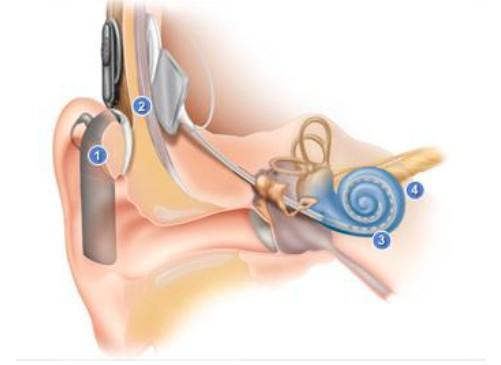 Come funziona un impianto cocleare. 1.