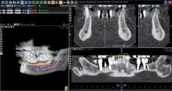 Apertura del caso comprensivo di TAC ed oggetti 3D allineati. Importare il database di B&B Dental alla prima installazione sul pc cliccando il tasto STRUMENTI.