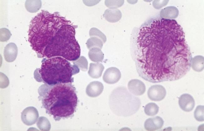 LEUCEMIA MIELOIDE ACUTA FAB M3 Promielocitica Promielociti