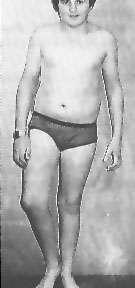 Netta associazione con obesità giovanile (sovrappeso il 50 % ) Sindrome adiposo-genitale Genesi traumatica (epifisiolisi acuta)