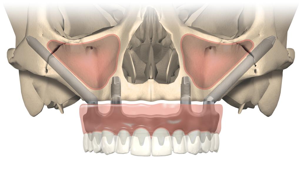 Tratta il riassorbimento severo senza innesti Scopri la maggiore flessibilità nel posizionamento dell'impianto zigomatico con i nuovi impianti NobelZygoma.