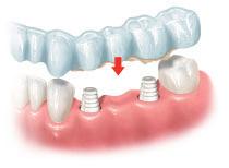 Le figure seguenti mostrano come utilizzare un abutment QuickTemp Conical.