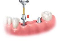 frequente per modificare i tessuti molli dopo l utilizzo di un abutment di guarigione (gestione