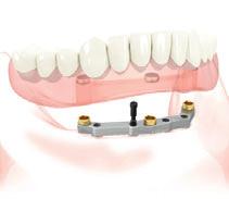 Le protesi includono abutment CAD/CAM personalizzati e prefabbricati, corone singole o arcate complete e barre per overdenture.