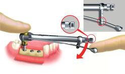 Nelle procedure protesiche, serrando l abutment e le viti protesiche al torque raccomandato si otterrà un controllo più efficace della giunzione a vite durante la funzione.