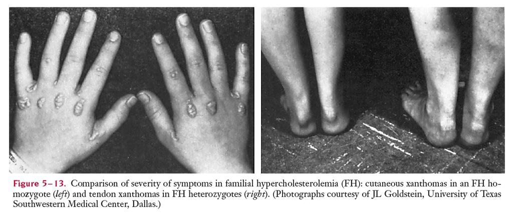 Ipercolesterolemia familiare (difetto nei recettori LDL) Autosomico dominante Elevati livelli di