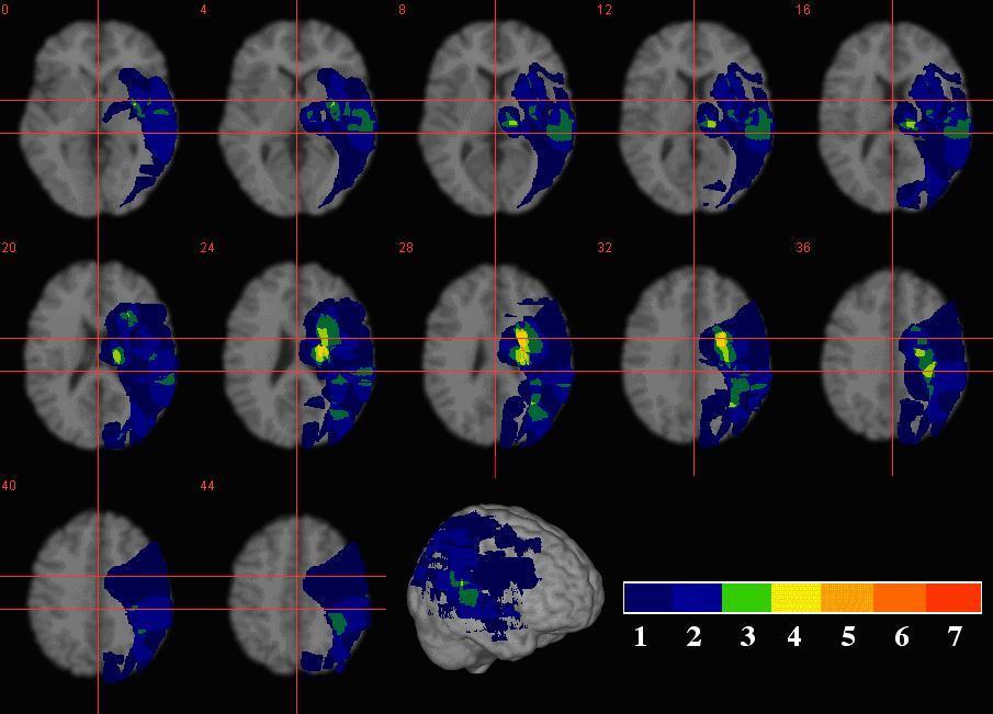 delle lesioni nei pazienti con hemiplegia, neglect e AHP (17 patients)