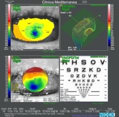 L immagine di sinistra mostra un caso di aberrazione causata da cheratotomia