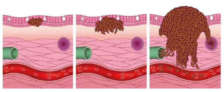 12 Immuno-oncologia, la nuova arma contro il melanoma Nivolumab è l unico inibitore del checkpoint immunitario PD-1 ad aver ricevuto una valutazione con procedura accelerata in Europa e il primo
