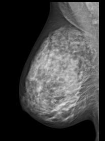 La ghiandola mammaria viene scomposta in tante immagini che poi, sovrapposte, ricostruiscono la figura della mammella nella sua