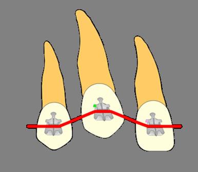 DEFORMAZIONE DELL ARCO La ridotta larghezza mesio-distale delle alette gengivali permette al professionista di flettere