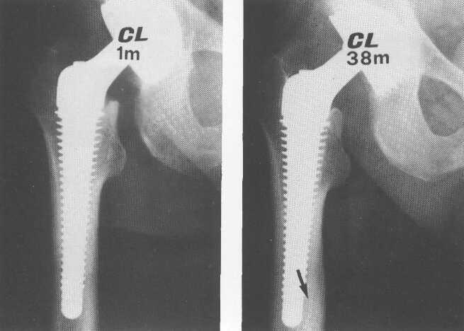 G. ANANIA, G. CASCIA, A. BOTTIGLIA, A. SCARCHILLI Fig. 7a Fig. 7b Fig. 7a e b C.L., uomo di 66 anni. A 38 mesi ipertrofia corticale distale prevalentemente mediale. Osteoporosi già presente.