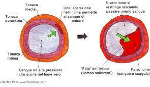 Il ventricolo sinistro si dilata fino ad assumere una