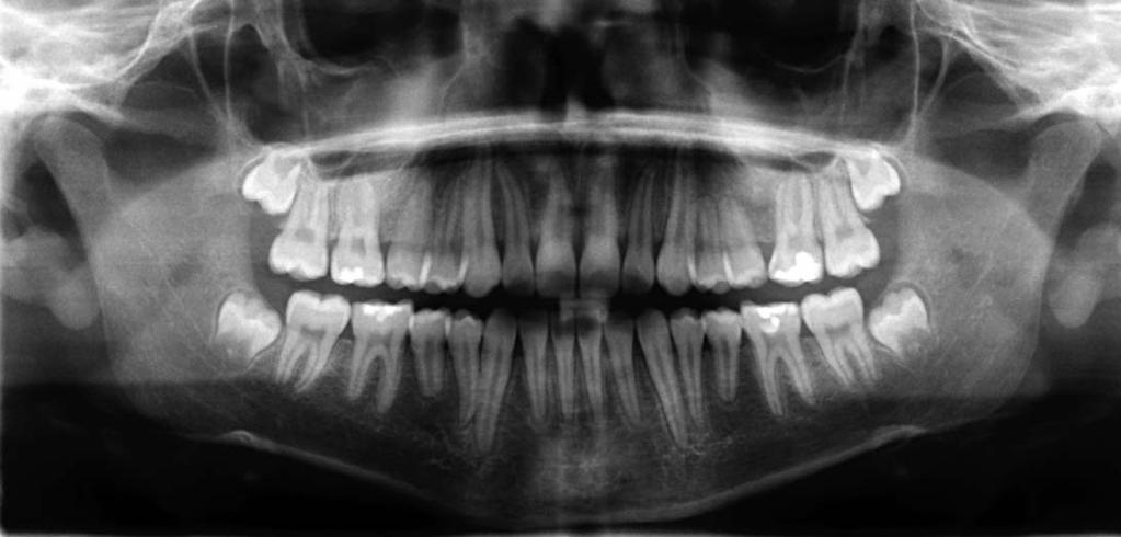 ottimali sul piano anatomico. Compensazione della colonna vertebrale mediante adattamento automatico dei kv, per una rappresentazione dettagliata dell area dei denti frontali.