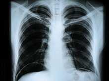 Radiografia Si basa sull'utilizzo dei raggi X e sull'effetto di frenamento dovuto