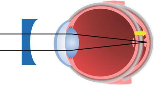 Strategia 2: strategie ottiche nel processo di miopizzazione ha un ruolo lo sfocamento visivo uno sfocamento ipermetropico (piano di fuoco dietro la retina) esita in un allungamento del bulbo uno