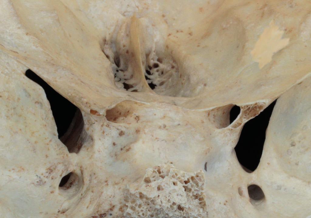 Anatomia sistematica del distretto craniofacciale CAPITOLO 1 ANTERIORE Crista galli Lamina cribrosa ottico Fessura orbitaria superiore MEDIA rotondo b MEDIA Impronta del ganglio di Gasser POSTERIORE