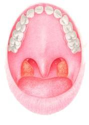 Ipertrofia tonsillare Preoperatorio Intraoperatorio Postoperatorio In genere, se si associa una patologia da ipertrofia dei turbinati,