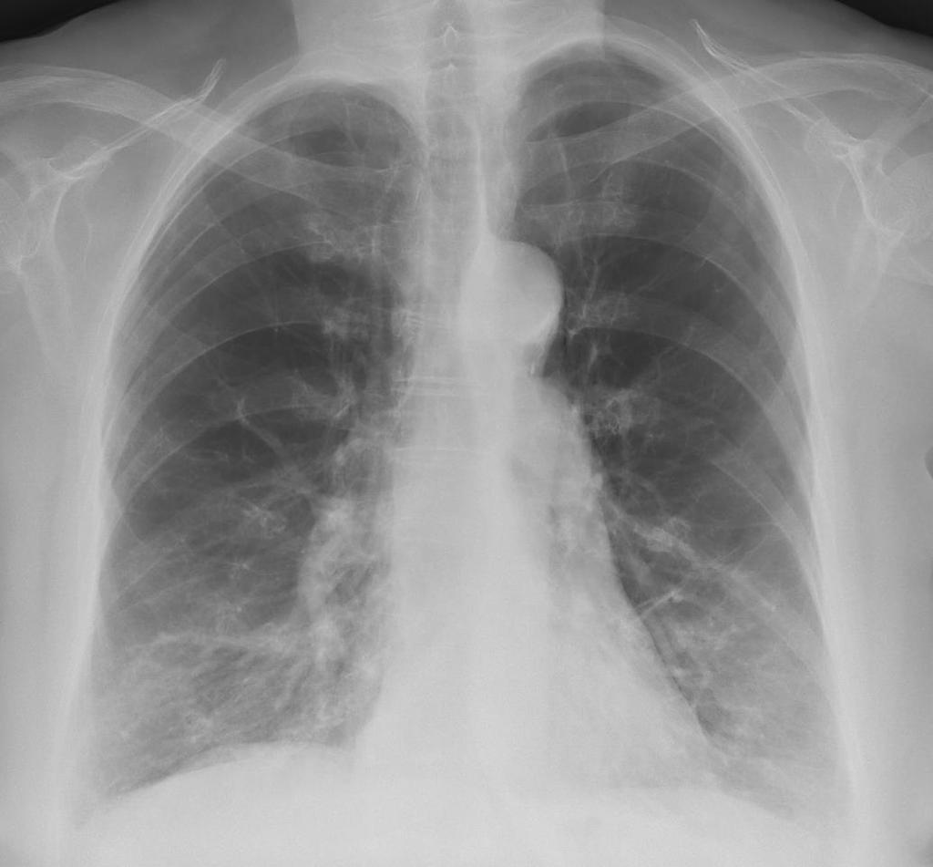 RX Torace Enfisema polmonare Segni RX Proiezione frontale 1.