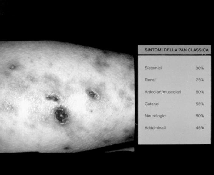 VASCULITI DEI PICCOLI VASI Vasculiti da ipersensibilità