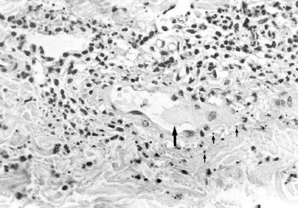 Vasculite leucocitoclastica polvere nucleare Deposizione di immunocomplessi Attivazione complemento via classica Chemotassi neutrofili