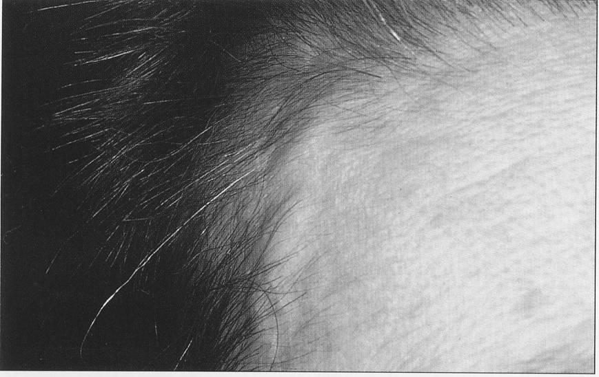 Diagnostic criteria for giant cell arteritis a. Positive biopsy b. Headache c. Tenderness of TA d. Scalp tenderness e. Jaw claudication f. Visual disturbances g. Optic neuritis h.