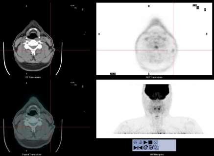 PET/CT con 18F-FDG CT PET Linfonodo l-c sin di lieve iperaccumulo