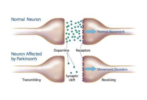 Parkinson: malattia degenerativa associata alla morte delle cellule neuronali coinvolte nella sintesi e rilascio di dopamina.