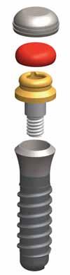 Piattaforma di connessione protesica Active 25 LOCATOR I Locator Abutment sono una soluzione protesica brevettata versatile, semplice e sicura per ancorare le overdenture agli impianti dentali.