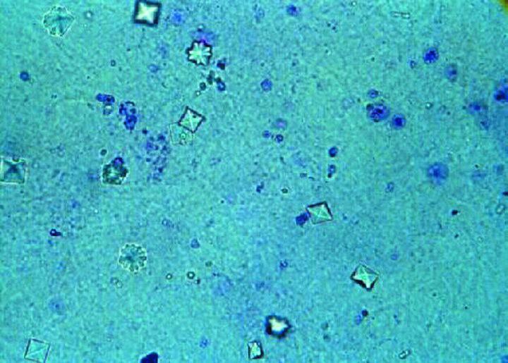 Esame microscopico del sedimento urinario Nell urina di soggetti normali il sedimento urinario è scarsissimo, si osservano normalmente elementi organizzati costituiti da elementi a struttura