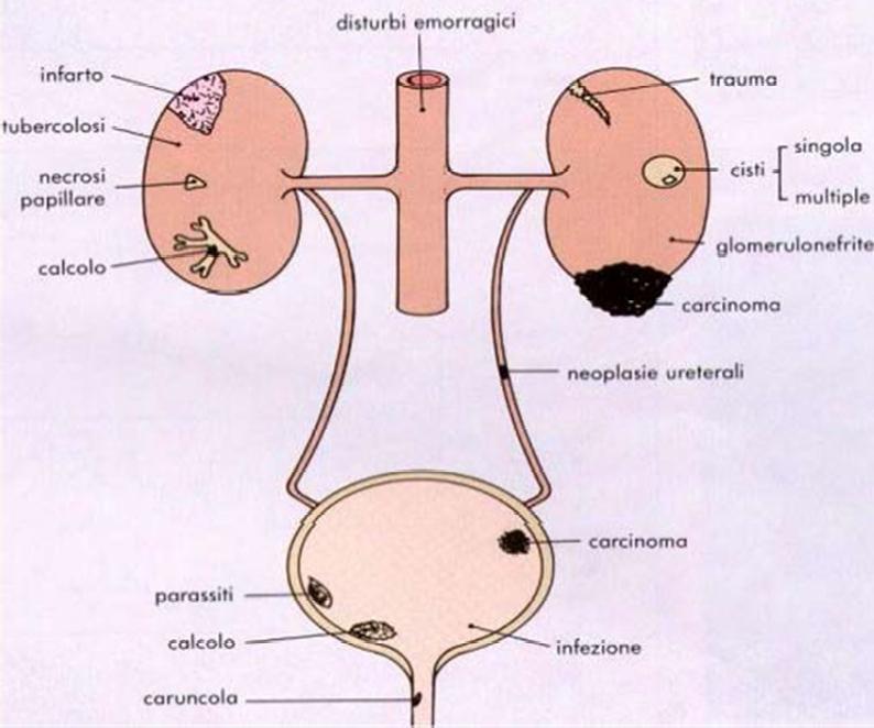 Cellule: globuli rossi (ematuria) Valori normali: 0-2 per campo Se presenti in grosse quantità: