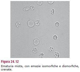 Cellule: globuli rossi (ematuria) Morfologia alterata: Emazie a margini raggrinziti