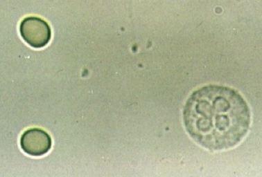 Cellule: globuli bianchi (leucocituria, piuria) Valori normali: inferiori ad un numero