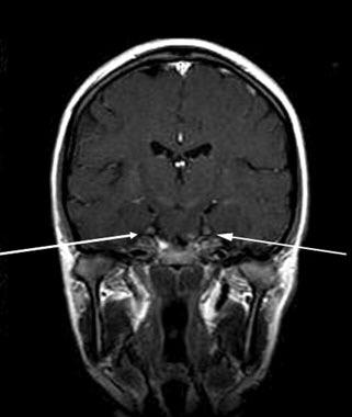 Ispessimento ed enhancement dei nervi cranici e spinali