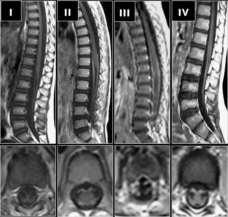 Enhancement radicolare (BEE) Ispessimento e spessore cono midollare No enhancement (nelle fasi precoci) II. Radici anteriori>posteriori (++) III.