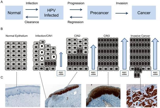 HPV e cancro della cervice: storia naturale
