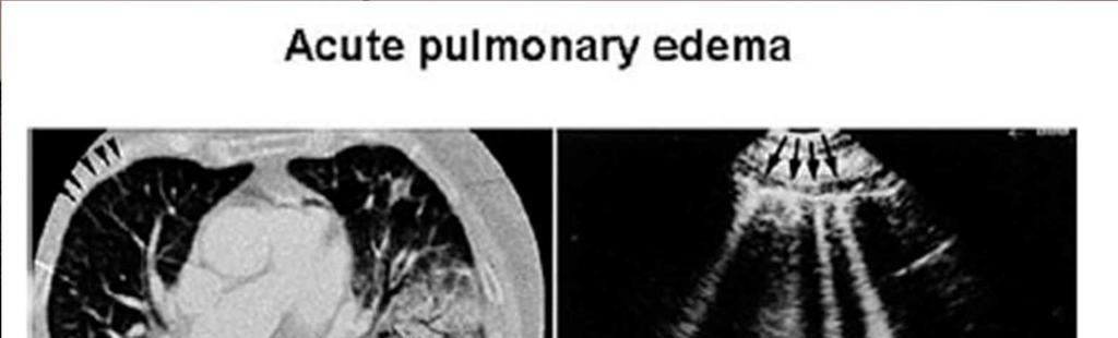 Thoracic