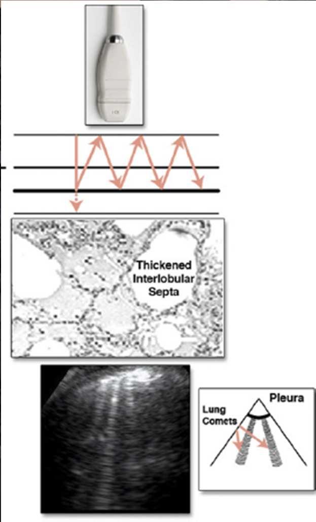 Detection of Pulmonary Congestion by