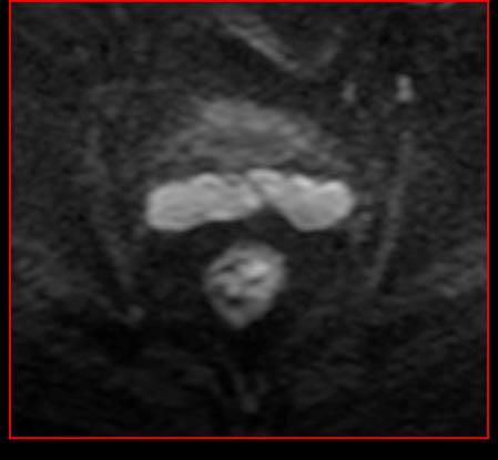 3 cm estesa per circa 4 cm a partire da 2 cm