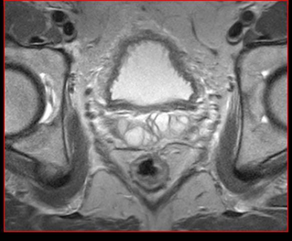 ..all odierno controllo si osserva disomogenea alterazione di segnale