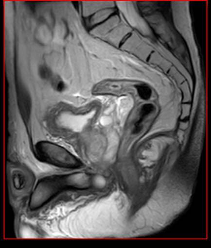 estesa per circa 0.7 cm a partire da 2.