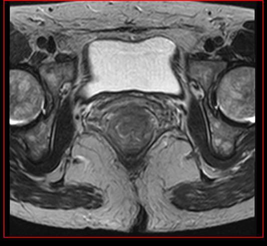 Neoformazione del retto basso, ulcerata, estesa