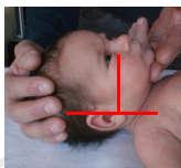 Il protocollo PBLS (Pediatric Basic Life Support) (fase A) Posizione neutra del capo del lattante